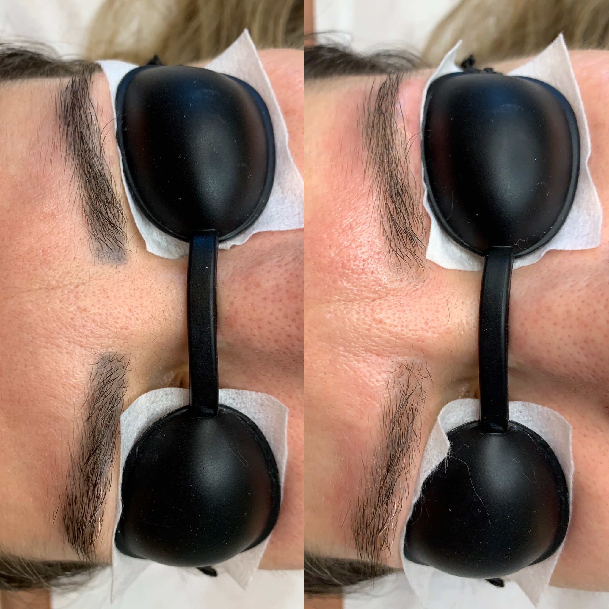 Resultado de remoção a laser